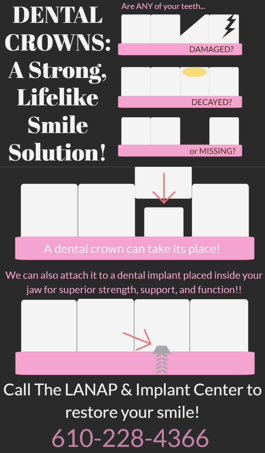 dental crowns